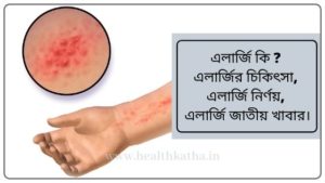 এলার্জি