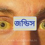 জন্ডিস