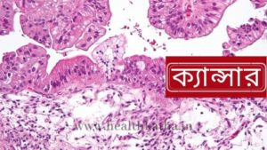 ক্যান্সার