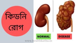 কিডনি রোগ