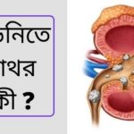 কিডনিতে পাথর
