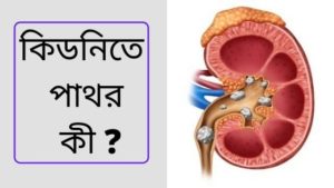 কিডনিতে পাথর