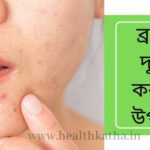 ব্রণ দূর করার উপায়