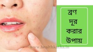 ব্রণ দূর করার উপায়